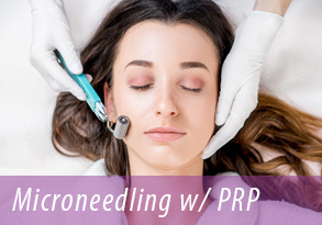 microneedling cda