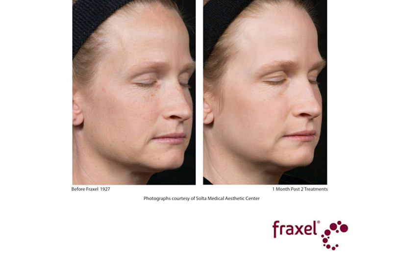 rejuvenation fraxel cda