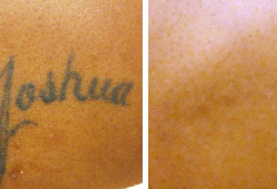 Tattoo Removal Treatment