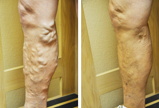 Varicose Vein Treatment - Legs