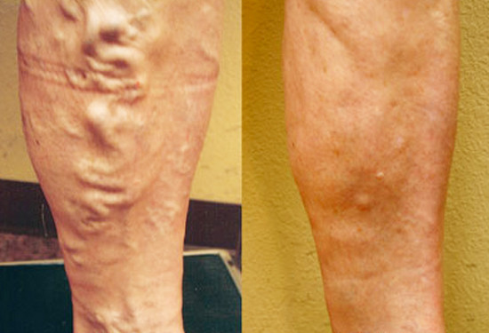 Varicose Vein Treatment - Legs