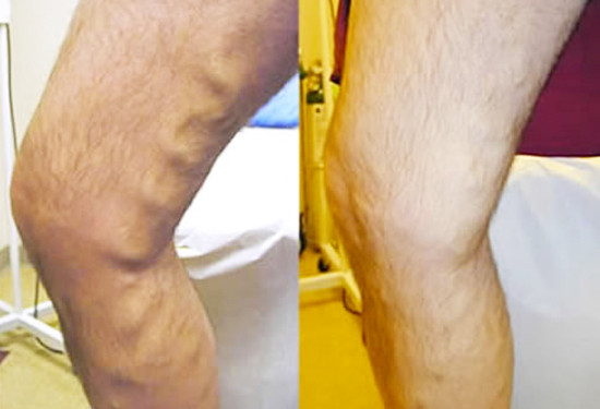 Varicose Vein Treatment - Legs