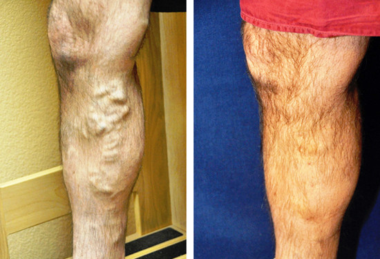 Varicose Vein Treatment - Legs