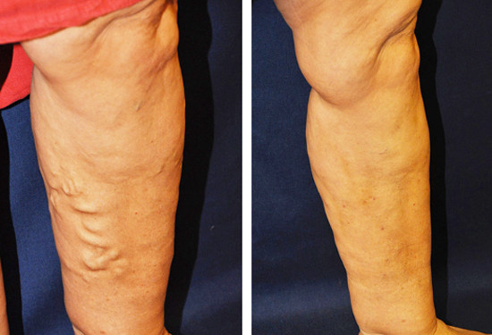 Varicose Vein Treatment - Legs