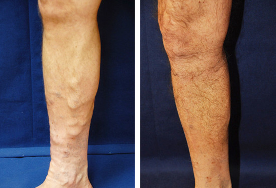 Varicose Vein Treatment - Legs