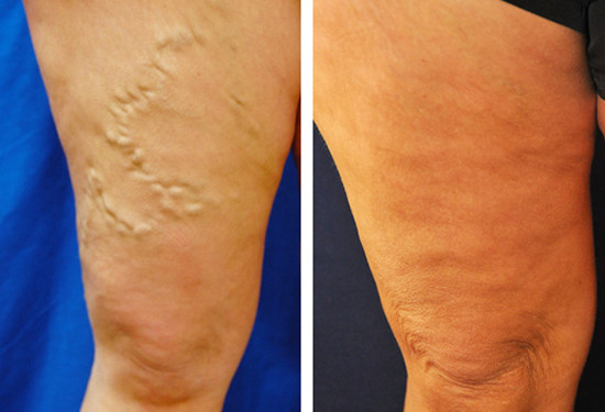 Varicose Vein Treatment - Legs