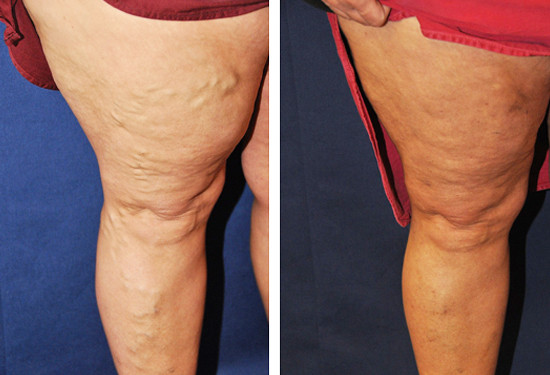 Varicose Vein Treatment - Legs