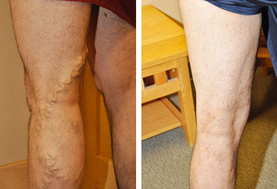 Varicose Vein Treatment - Legs