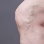 varicose veins untreated cda