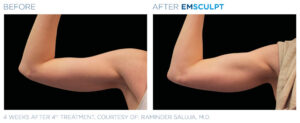 emsculpt body shaping coeur d alene female arm 2