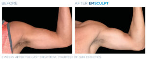 emsculpt body shaping coeur d alene male arm