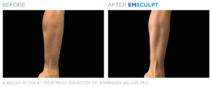 emsculpt body shaping coeur d alene male leg