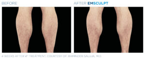 emsculpt body shaping coeur d alene male legs 2