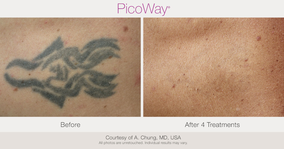 tattoo removal before and after